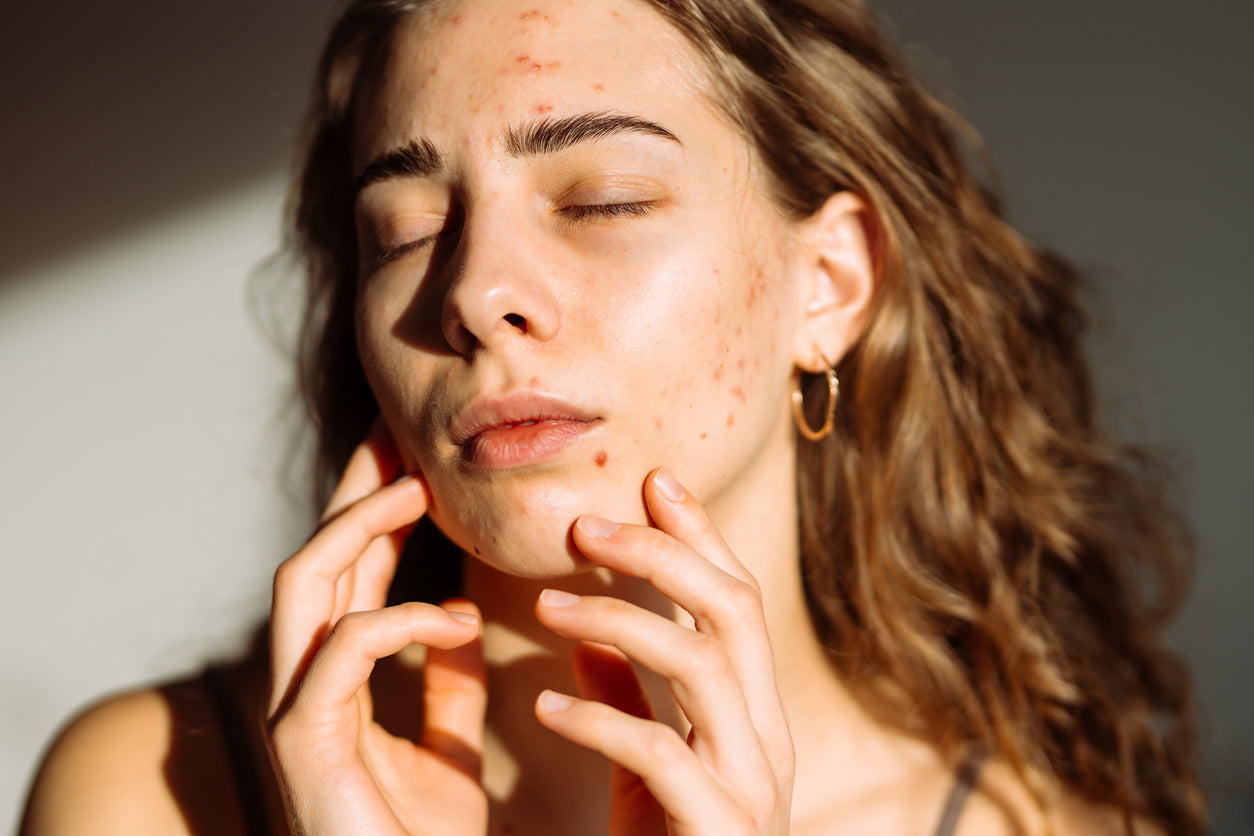 Female face with visible acne and redness under soft lighting